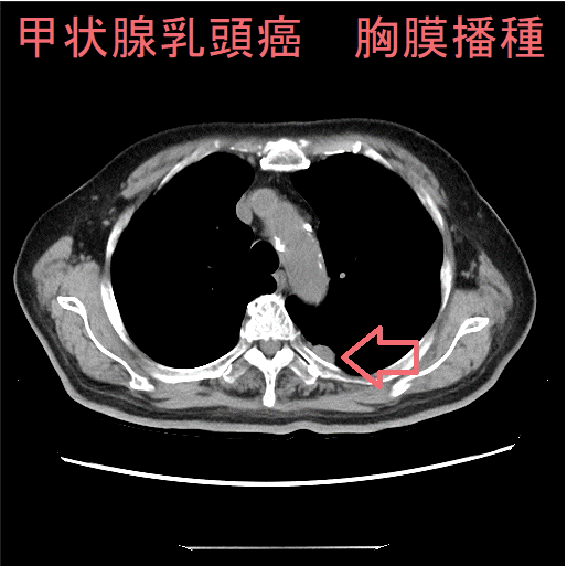 甲状腺乳頭癌　胸膜播種 CT画像2
