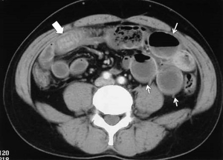 小腸アニサキス症 CT画像