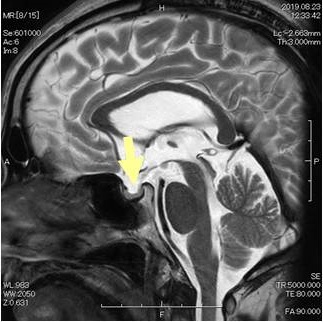 エンプティ・セラ症候群 MRI 画像
