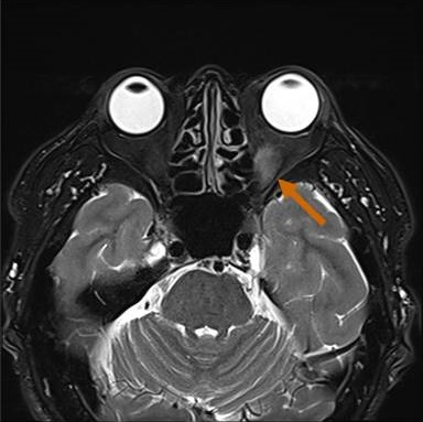 遅延型バセドウ病眼症　MRI画像