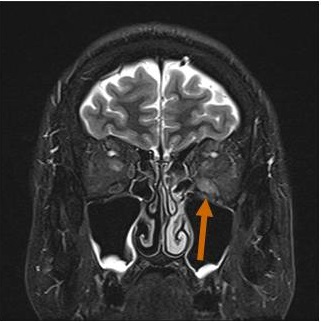 遅延型バセドウ病眼症　MRI画像
