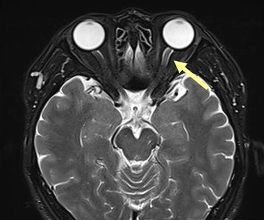視神経炎 MRI画像