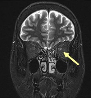 視神経炎 MRI画像