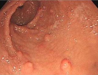 コーデン(Cowden)症候群 胃ポリポーシス