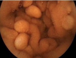 コーデン(Cowden)症候群 小腸ポリポーシス