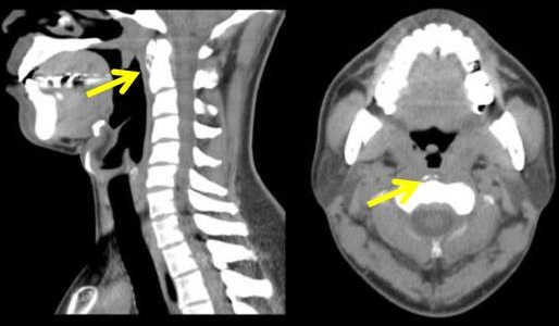 石灰沈着性頚長筋腱炎 CT画像