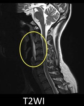 石灰沈着性頚長筋腱炎 MRI画像
