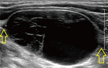 頚部神経鞘腫(schwannoma) 超音波(エコー)画像