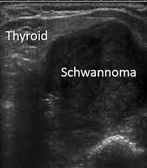 甲状腺神経鞘腫（シュワノーマ）　超音波(エコー)画像