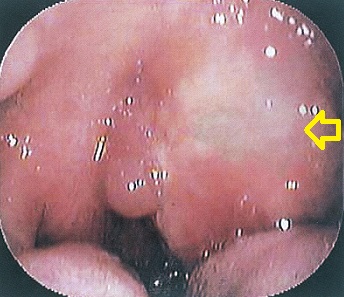 扁桃周囲膿瘍 口腔内