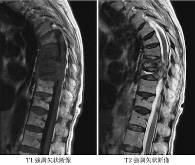 脊椎カリエス MRI画像