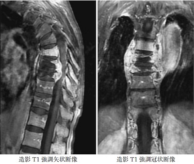 脊椎カリエス 造影MRI画像