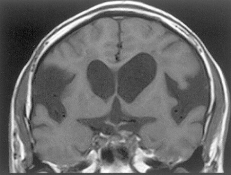 特発性正常圧水頭症 MRI画像