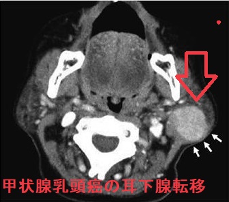 甲状腺乳頭癌の耳下腺転移 造影CT