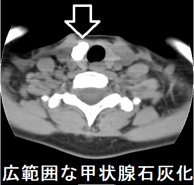 甲状腺内石灰化 CT画像