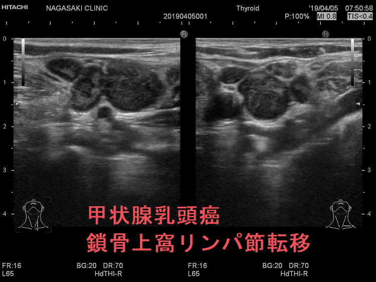 甲状腺乳頭癌 鎖骨上窩リンパ節転移 超音波(エコー)画像
