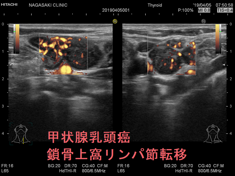 甲状腺乳頭癌 鎖骨上窩リンパ節転移 超音波(エコー)画像 ドプラーモード