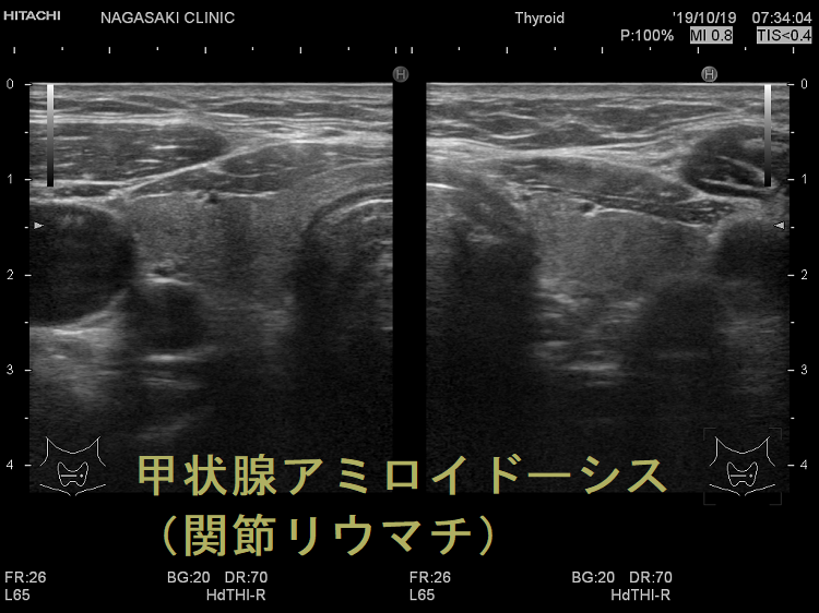 甲状腺アミロイドーシス（関節リウマチ）超音波(エコー)画像
