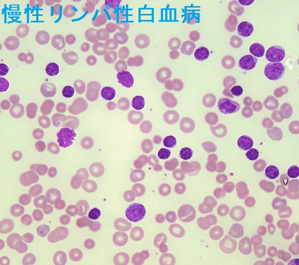 慢性リンパ性白血病