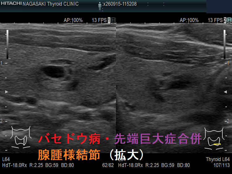 バセドウ病・先端巨大症合併 腺腫様結節 超音波(エコー)画像 (拡大) バセドウ病・先端巨大症合併 腺腫様結節 超音波(エコー)画像 (拡大)