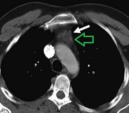 胸腺過形成 CT画像