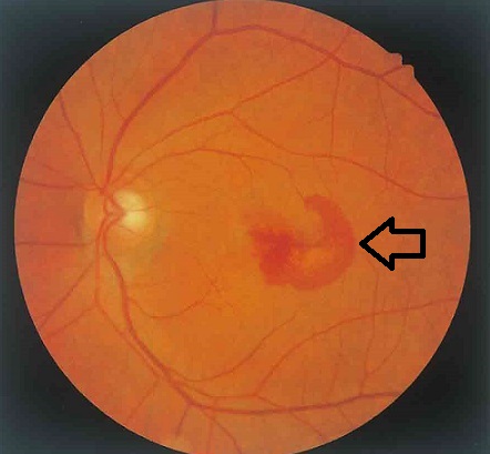 加齢黄斑変性 眼底検査