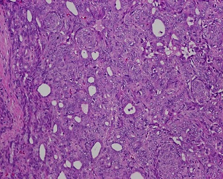 甲状腺乳頭癌モルラ型 病理組織モルラ(渦巻状)構造