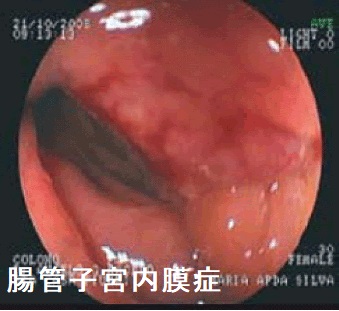腸管子宮内膜症