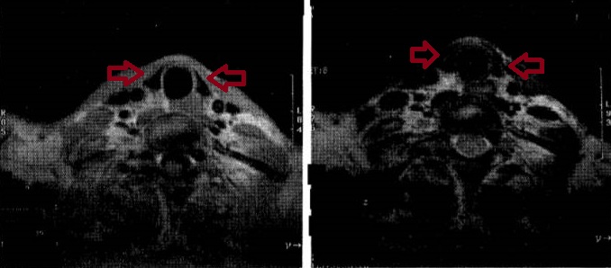 甲状腺単純MRI　Tl,T2強調画像