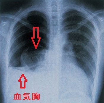 血気胸　胸部エックス線写真