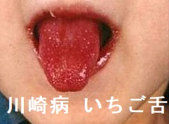 川崎病 いちご舌