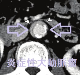 炎症性大動脈瘤 大動脈造影CT