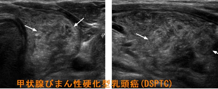甲状腺びまん性硬化型乳頭癌(DSPTC)　超音波(エコー)画像