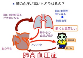 肺高血圧症と甲状腺