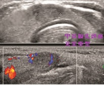甲状腺乳頭癌充実亜型 超音波(エコー)画像