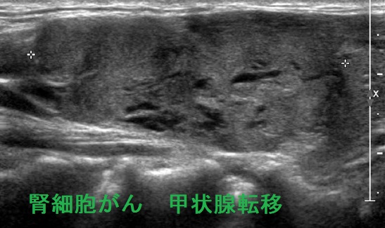 腎細胞がん　甲状腺転移 超音波(エコー)画像