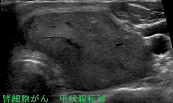 腎細胞がん　甲状腺転移 超音波(エコー)画像