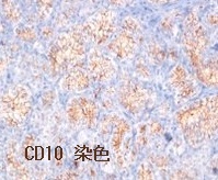 腎細胞がん　甲状腺転移 組織診　CD10 染色