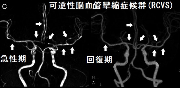 筋線維束性攣縮