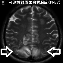 可逆性後頭葉白質脳症（PRES）
