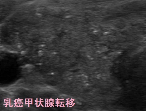 乳癌甲状腺転移  超音波(エコー)画像