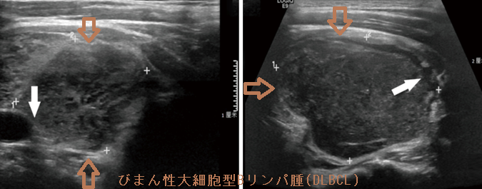 びまん性大細胞型Bリンパ腫（DLBCL）超音波(エコー)画像