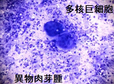 異物肉芽腫 細胞診