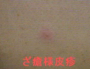 ベーチェット病の結節性紅斑様皮疹