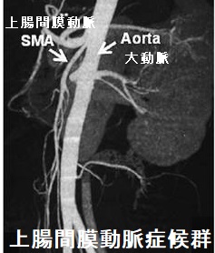 上腸間膜動脈症候群 腹部血管3D-CT