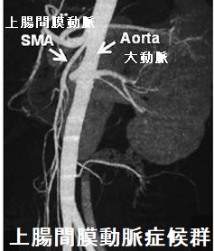 膜 動脈 上 症候群 間 腸 上腸間膜動脈症候群