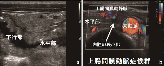 上 腸 間 膜 動脈 症候群 と は