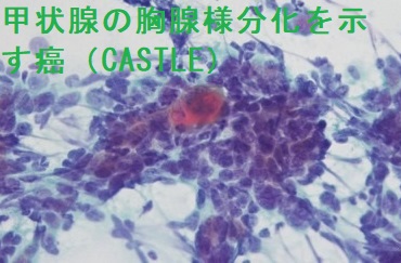 甲状腺の胸腺様分化を示す癌（CASTLE）細胞診 扁平上皮細胞