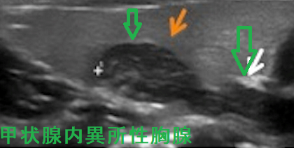 甲状腺内異所性胸腺 超音波(エコー)画像