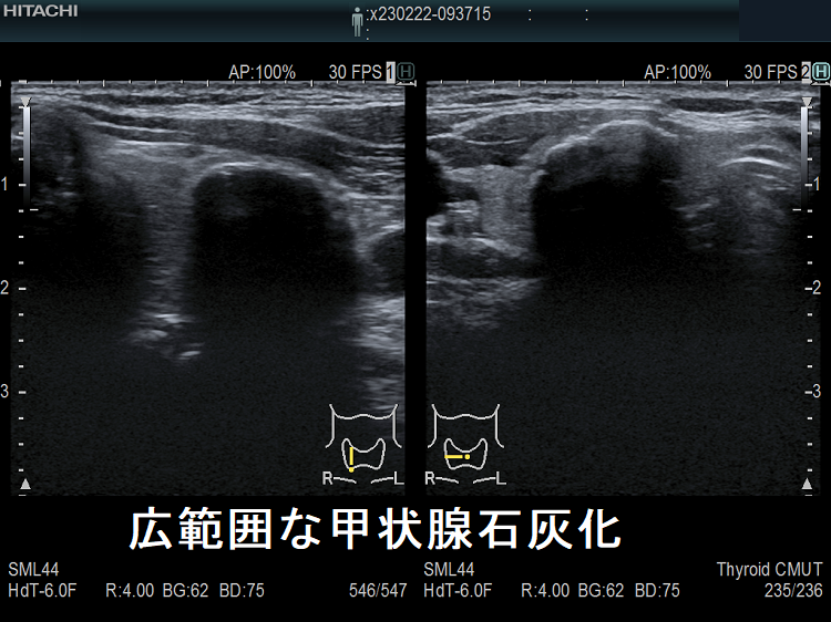 甲状腺内 線状石灰化 超音波(エコー)画像